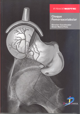 Choque femoroacetabular